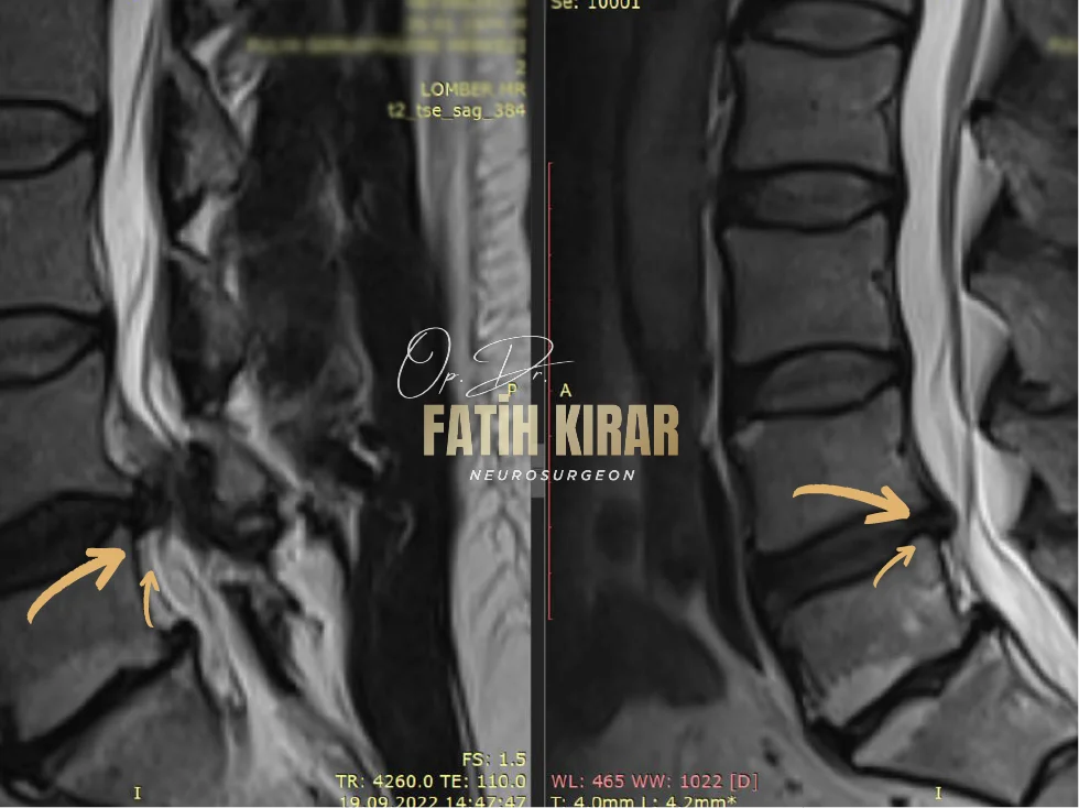 Hernia before after result 1