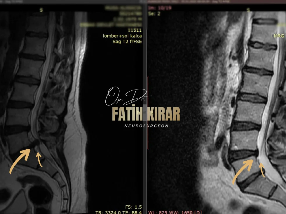 Hernia before after result 2