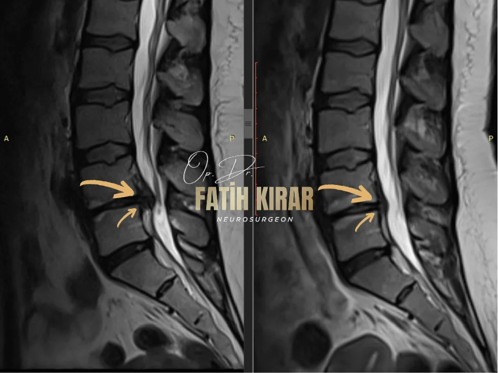 Hernia before after result 3