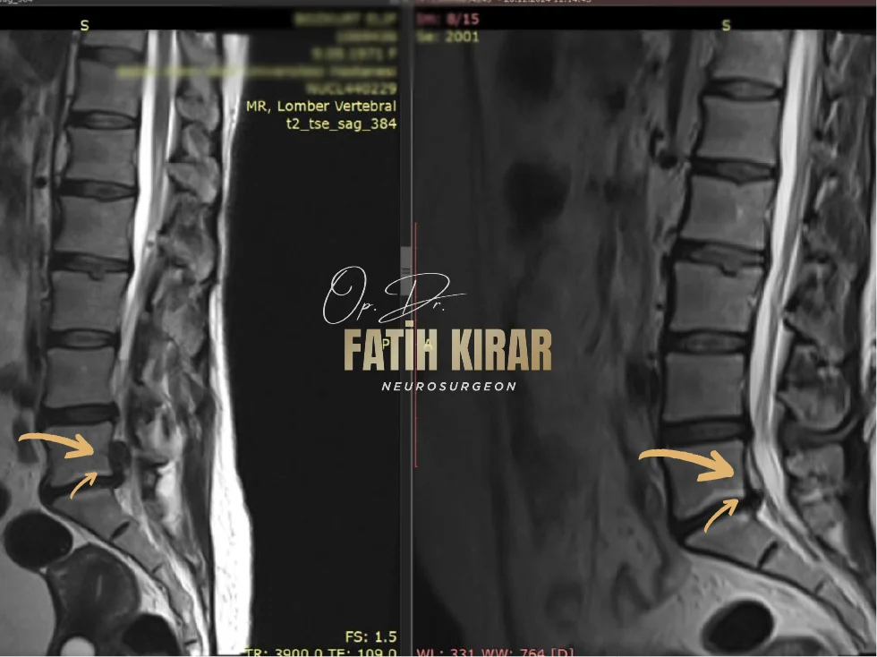 Hernia before after result 4