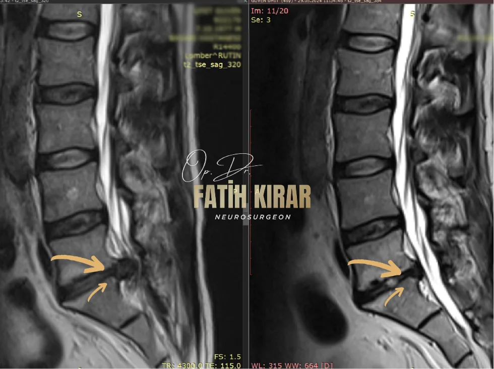 Hernia before after result 5