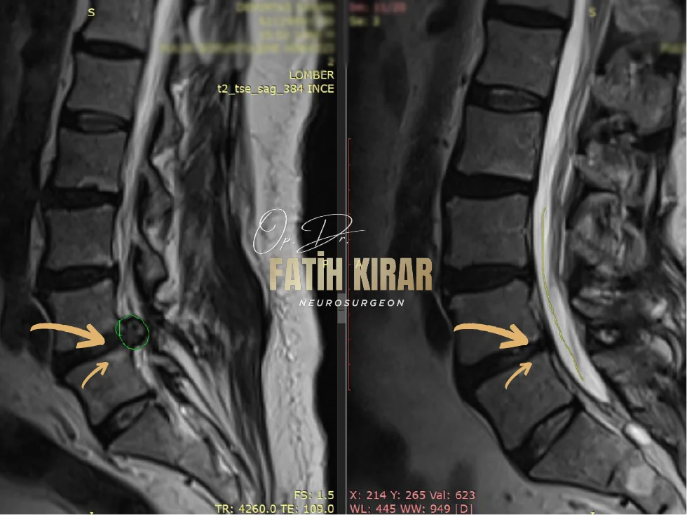 Hernia before after result 6