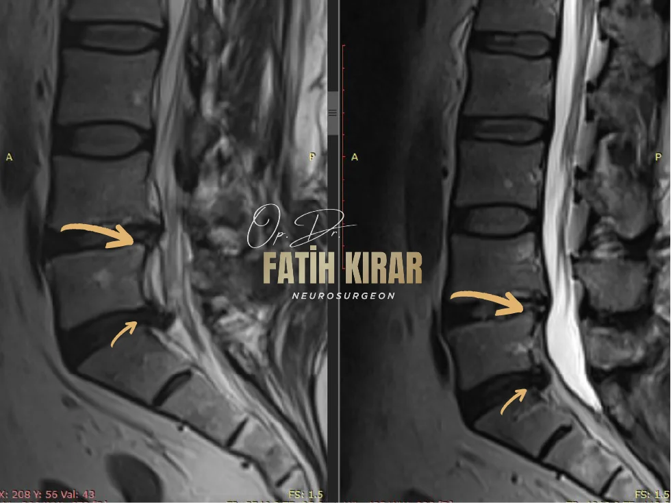 Hernia before after result 7