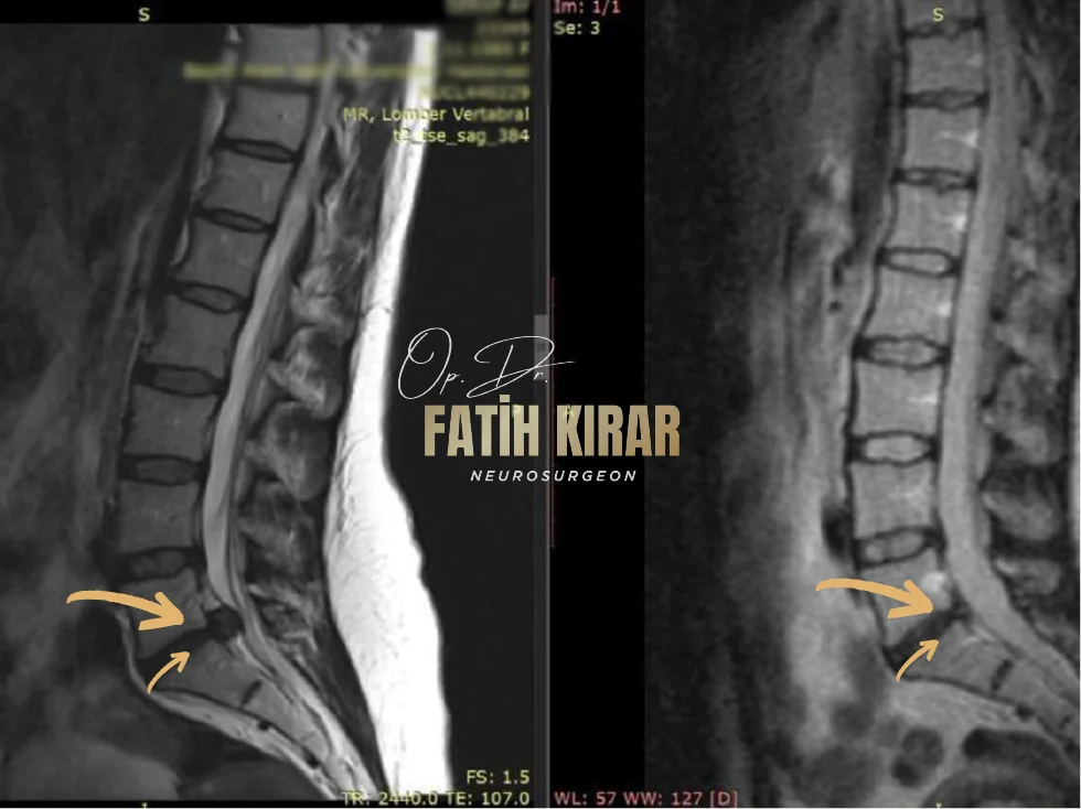 Hernia before after result 8
